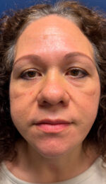 Facelift