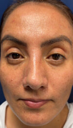 Rhinoplasty