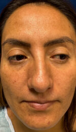 Rhinoplasty