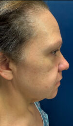 Facelift