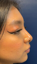 Rhinoplasty