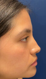 Rhinoplasty
