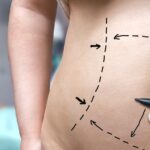 Plastic surgery concept. Hand is drawing lines with marker on belly