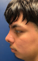 Rhinoplasty