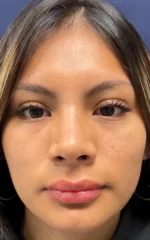 Rhinoplasty