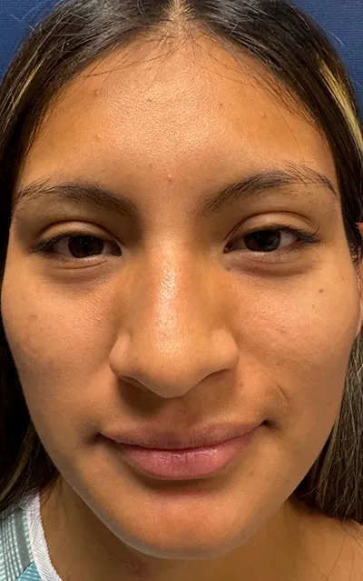 Rhinoplasty