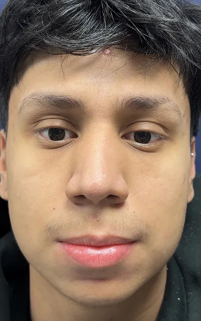 Rhinoplasty