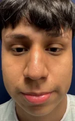Rhinoplasty