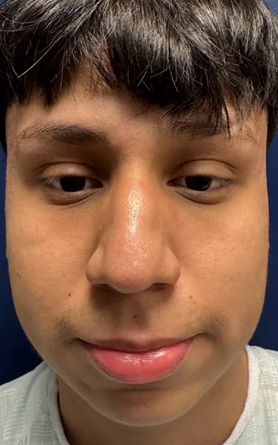 Rhinoplasty
