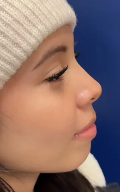 Rhinoplasty